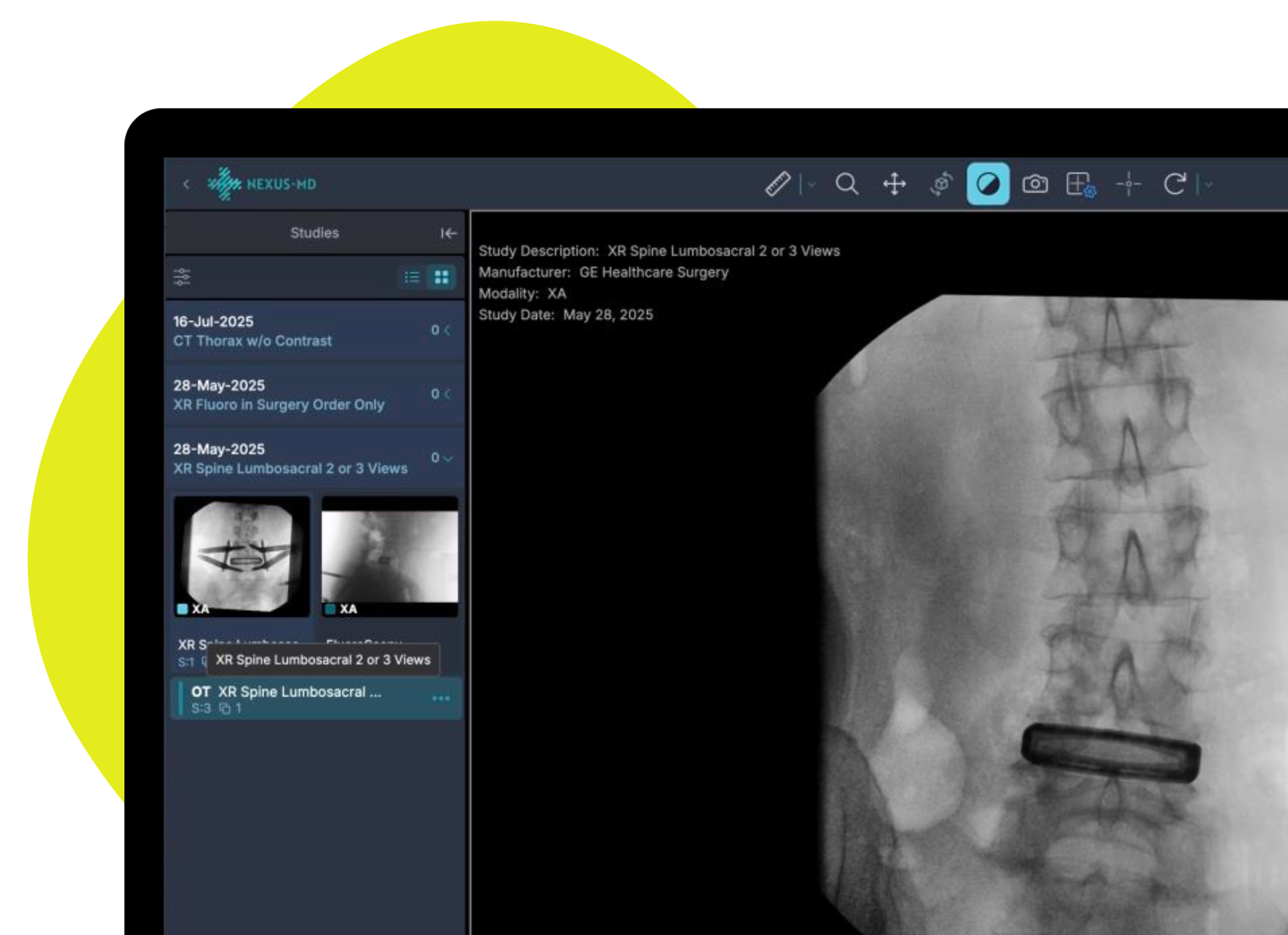 Nexus-MD DICOM Viewer interface showing XR Spine Lumbosacral study with patient imaging data and diagnostic tools
